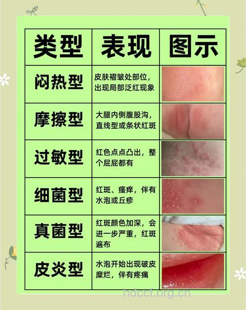 什么是儿童尿布疹