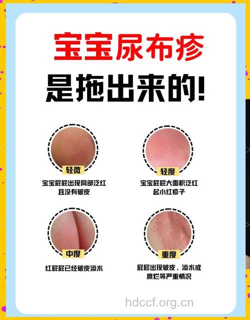 尿布疹会引发的症状