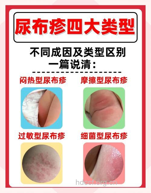 婴儿尿布疹与湿疹该如何来区别