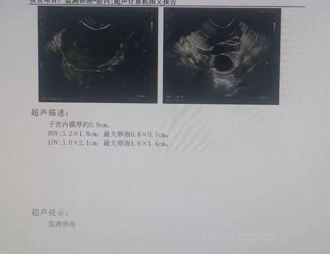 B超监测排卵 可提高成功受孕率