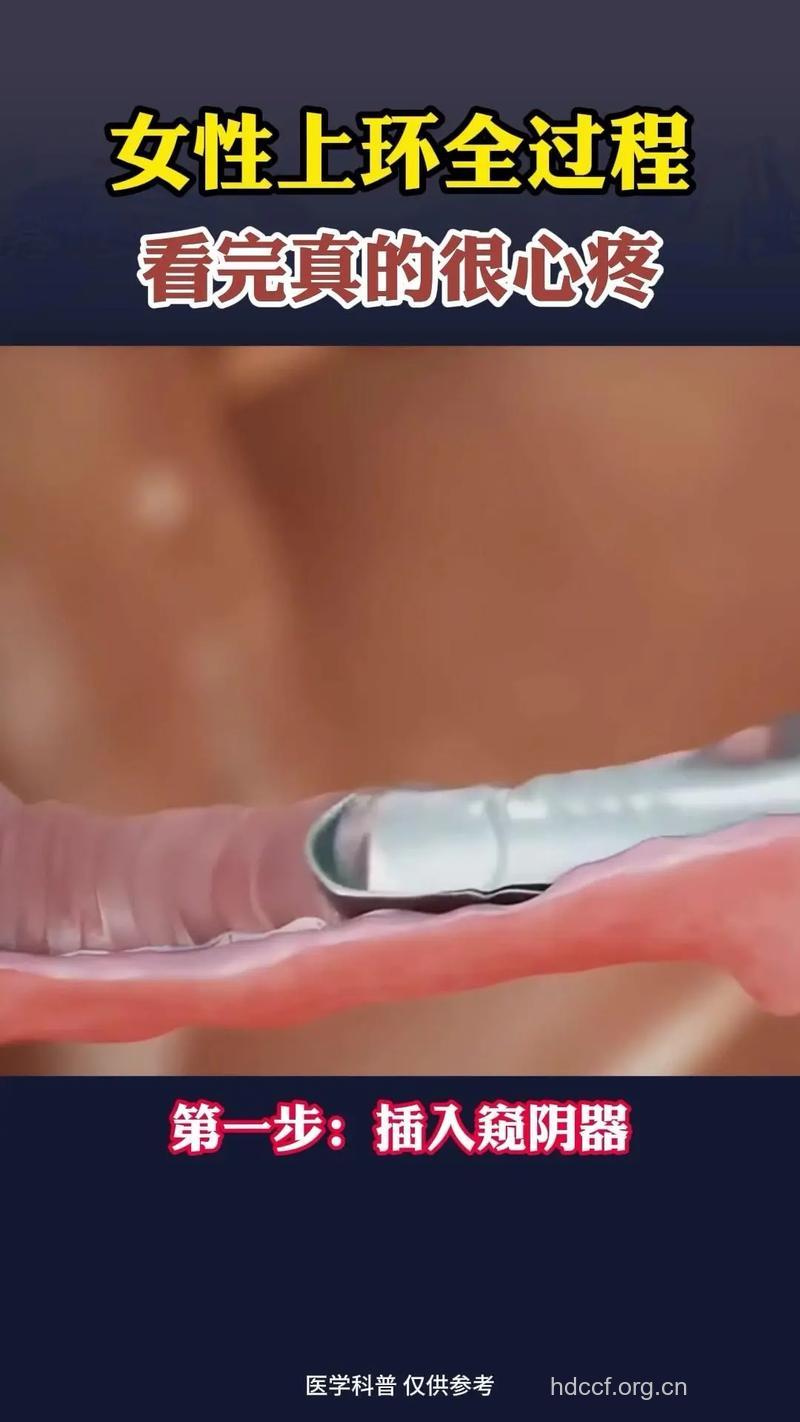 取环过程解析 准备取环的女性看看吧