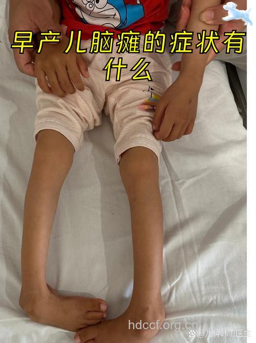 早产儿脑瘫表现及合并症