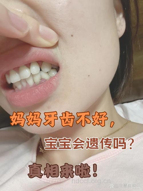 父母牙齿不好 会遗传给孩子吗