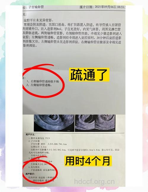 经历宫外输卵管通而不畅 备孕成功经验分享