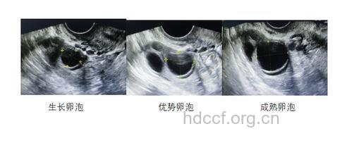 女性月经不调如何备孕？做好B超监测排卵