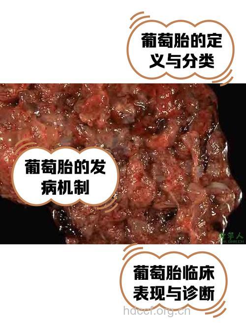经历葡萄胎 备孕成功经验分享