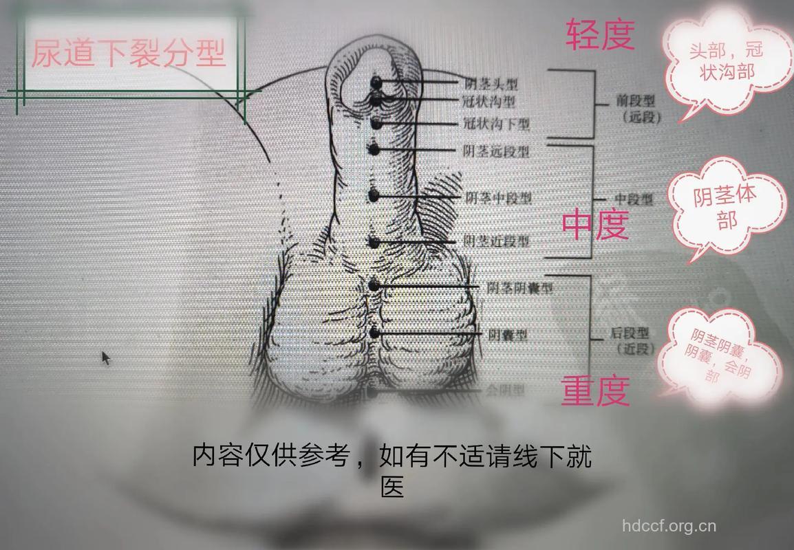小儿尿道下裂是怎么回事
