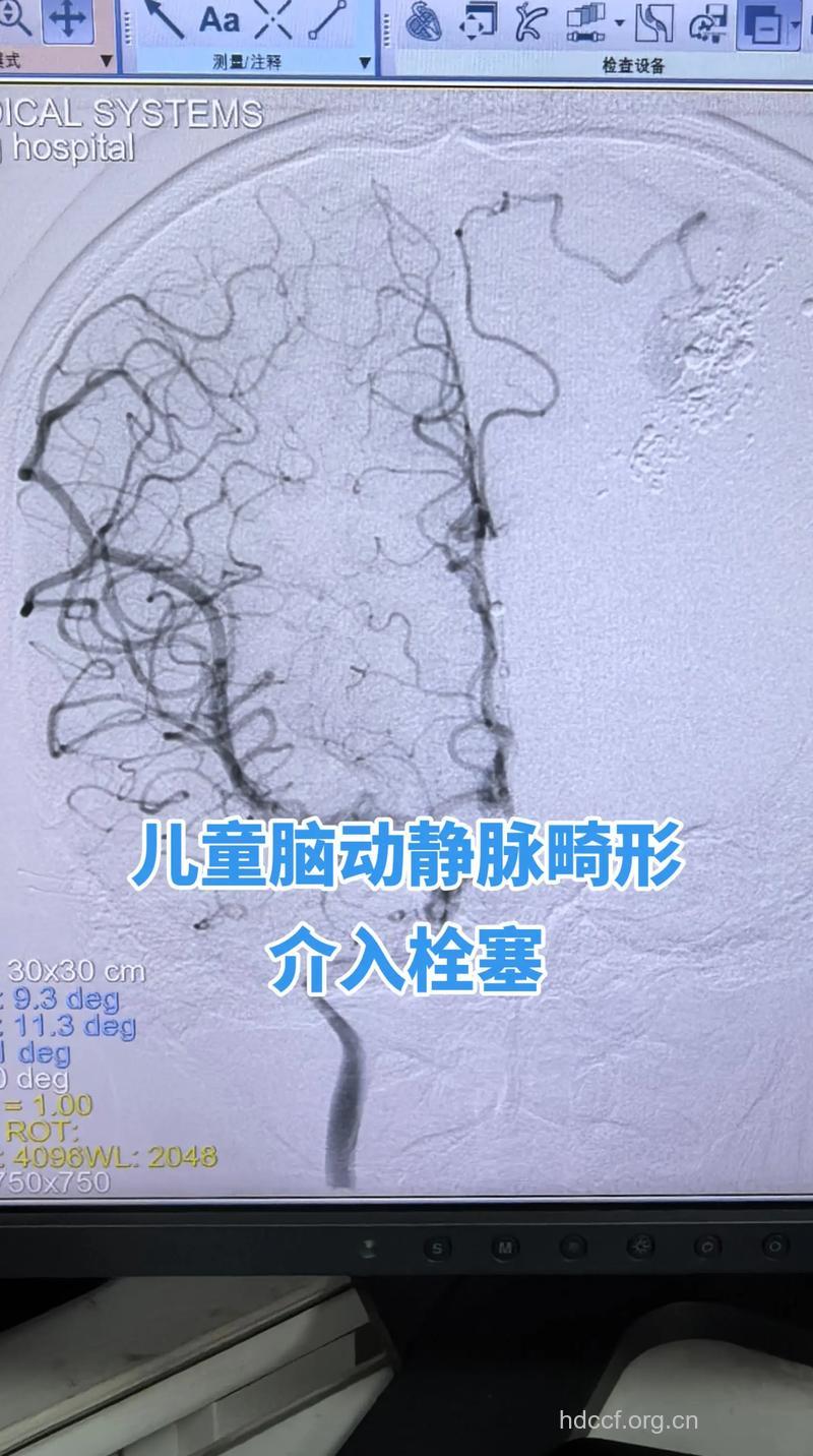 小儿脑血管畸形怎么治疗