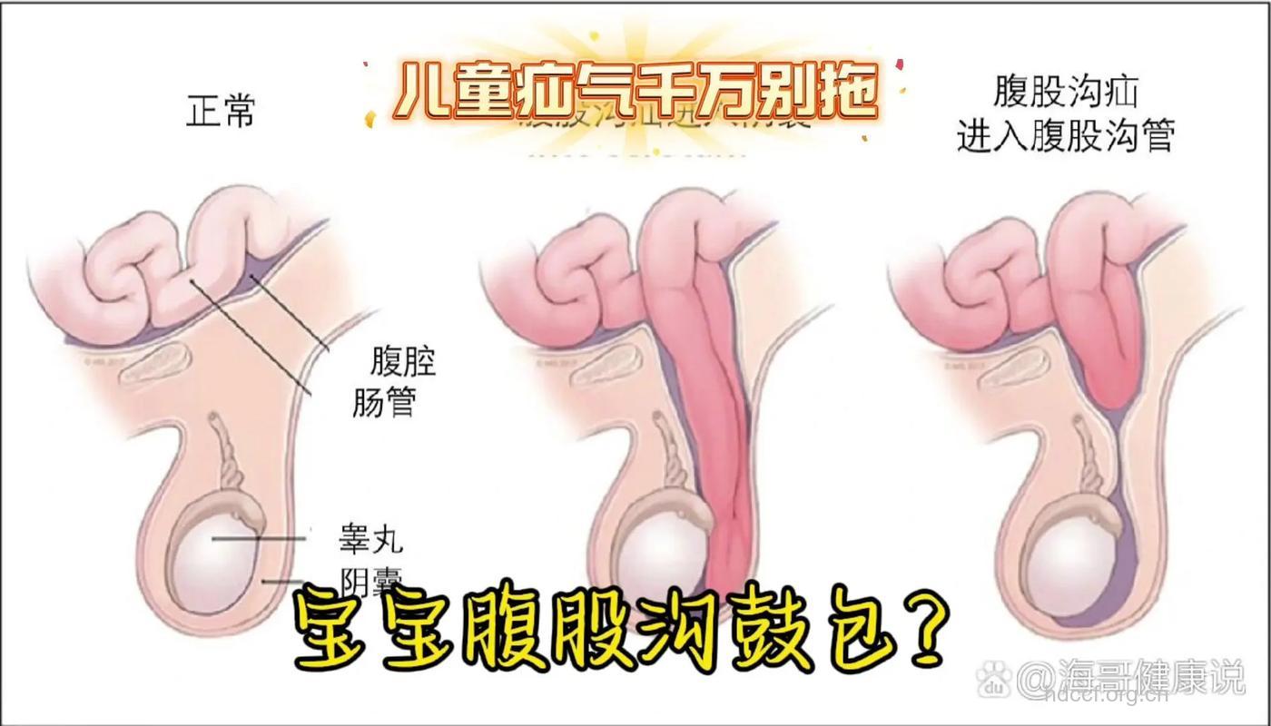 婴儿疝气是怎么回事