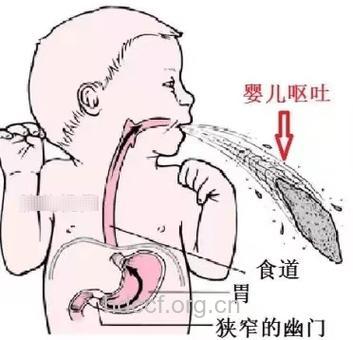 新生儿疾病:幽门狭窄