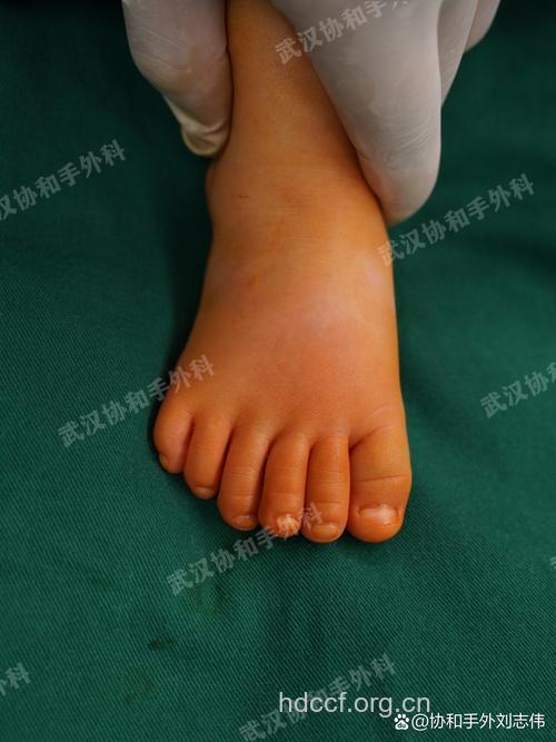 新生儿疾病：畸形足