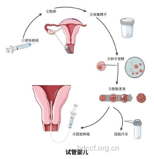 卵子是怎么取出来的 揭秘取卵过程