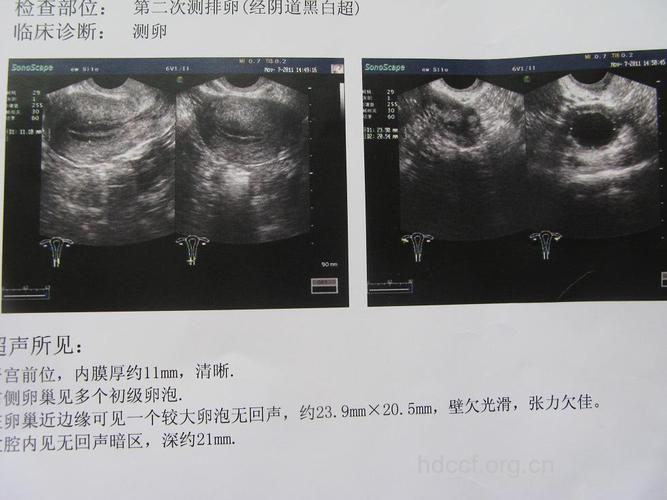 排卵监测 B超监测最为准确