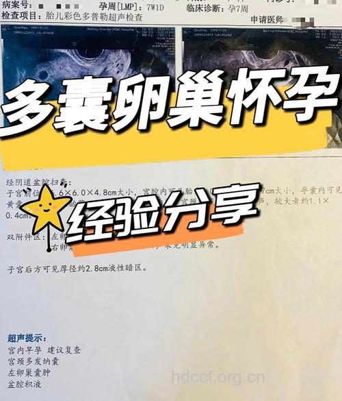 备孕成功经验 30岁患卵巢囊肿后成功受孕