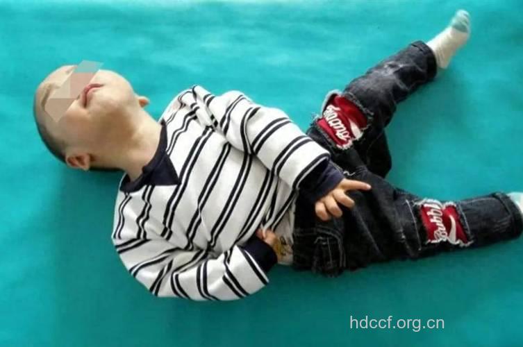 脑瘫小儿易表现哪些现象