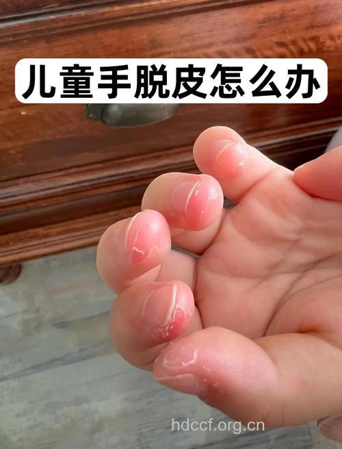 中医教你治疗儿童春秋季手足脱皮症