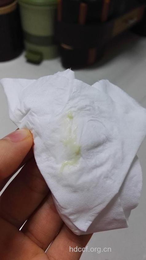 怀孕初期白带症状变化