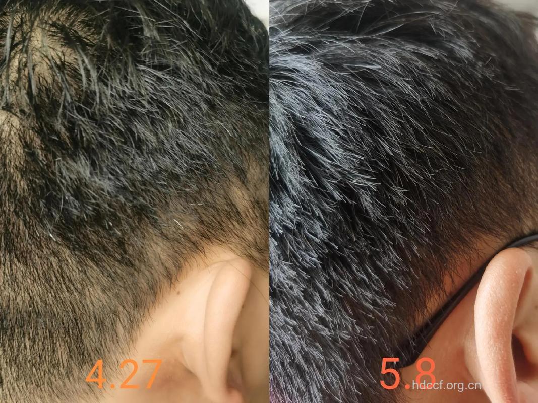 老公少白头 会遗传孩子吗