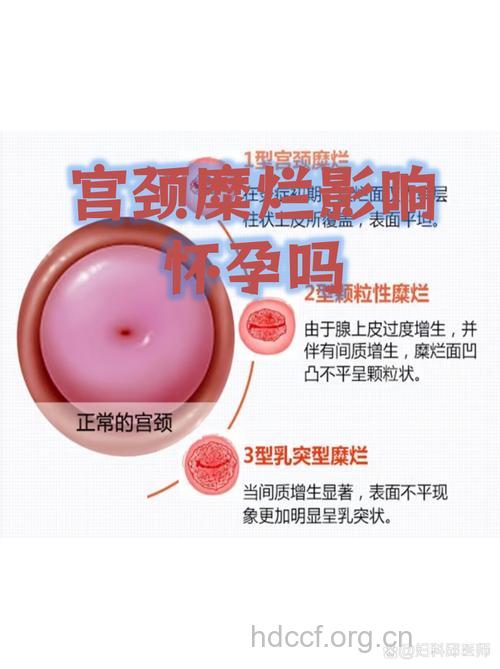 宫颈糜烂影响怀孕吗 其实没有那么严重