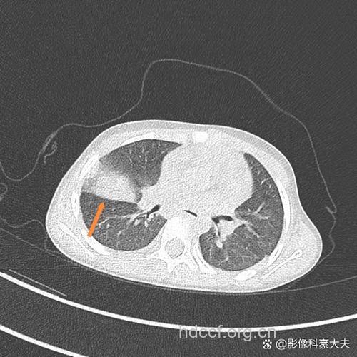 小儿肺炎要做CT吗
