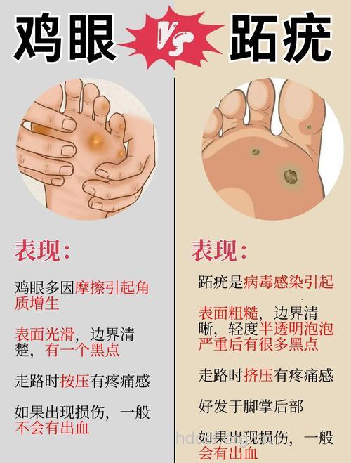 孕妇脚底长鸡眼怎么办