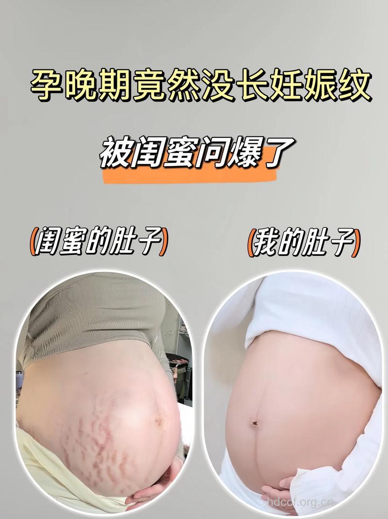孕期狂长妊娠纹 可能这些事没做好