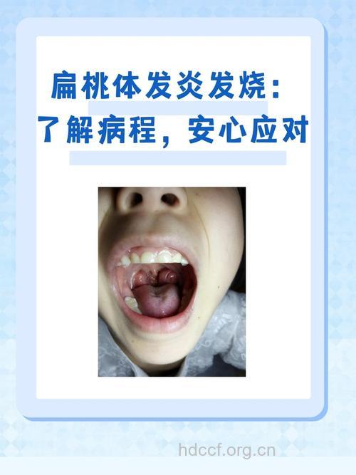 宝宝扁桃体发炎发烧怎么办