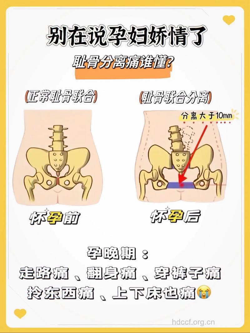 孕期耻骨疼痛 千万别不当回事儿