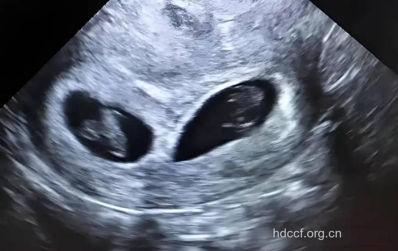 怀孕第29周双胞胎B超图