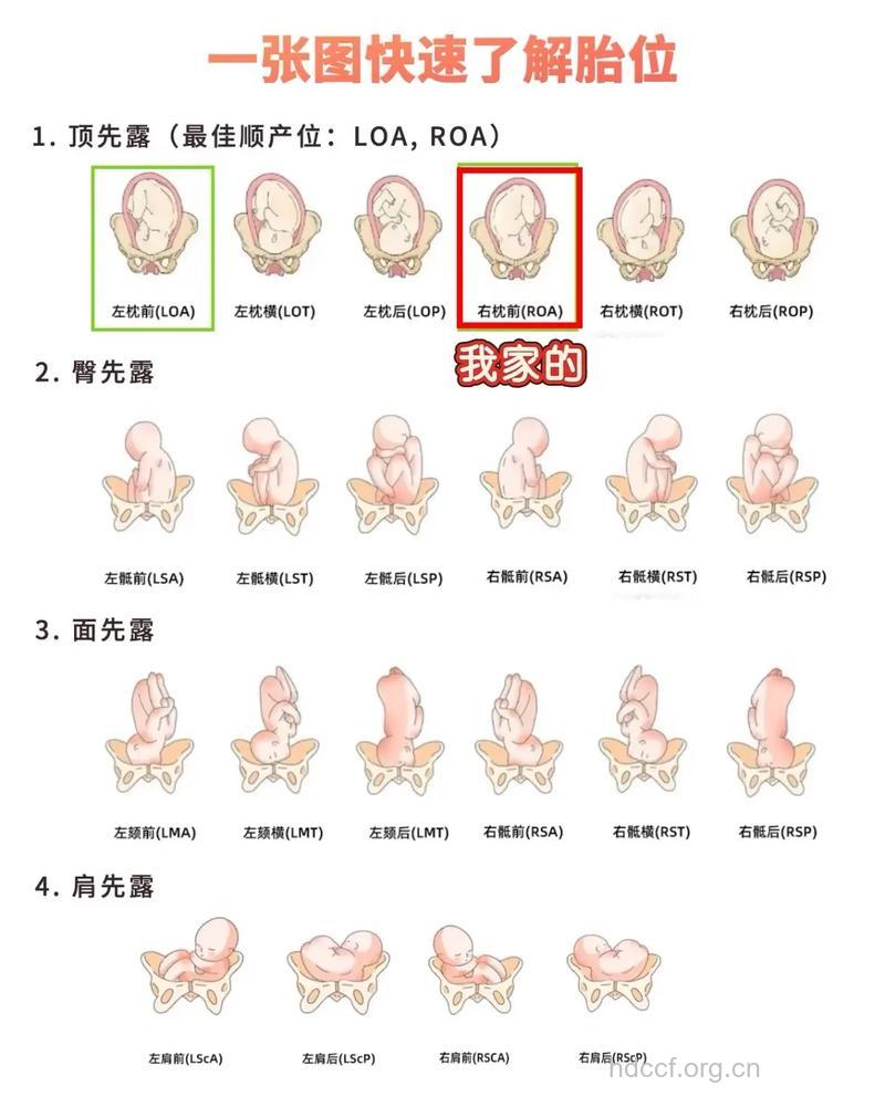 图示胎位 怀孕31周胎儿胎位图