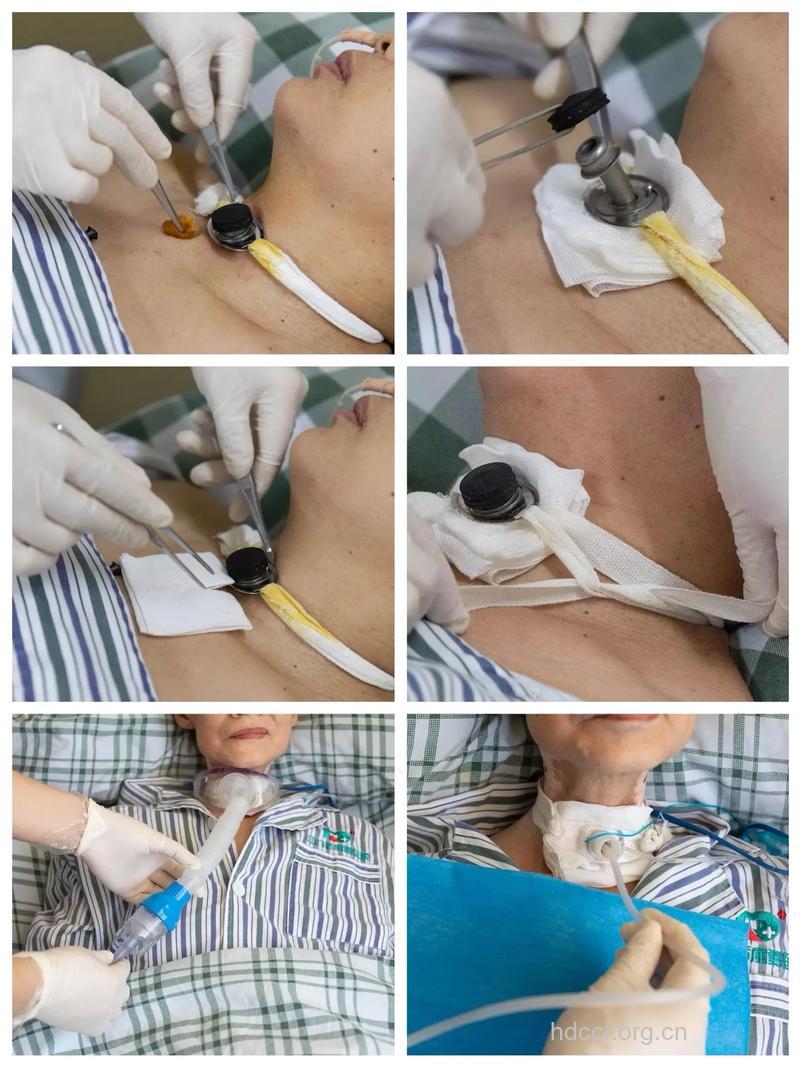 支气管扩张手术后护理方法