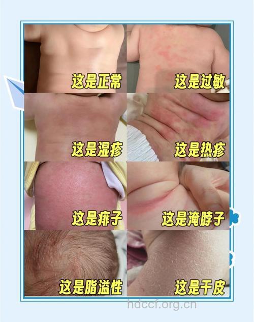 3种影响胎儿的皮肤疾病