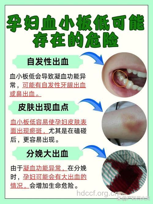 孕妇血小板减少怎么办