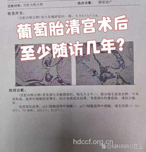 患者必知 葡萄胎刮宫术后的随访要坚持2年