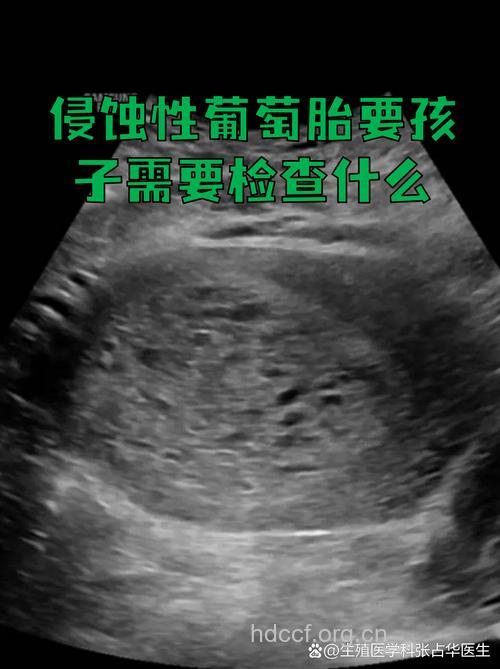 侵蚀性葡萄胎是什么 严重吗