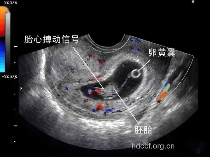 孕早期B超 葡萄胎有孕囊吗