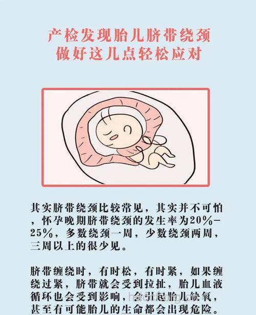 胎儿脐带绕颈该怎么办