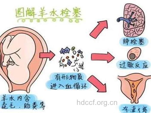 羊水栓塞孕妈妈该如何来预防