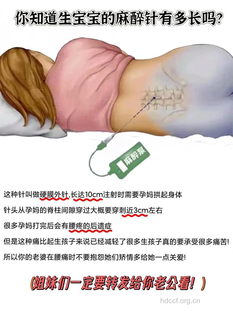 关于分娩麻醉的一些常识
