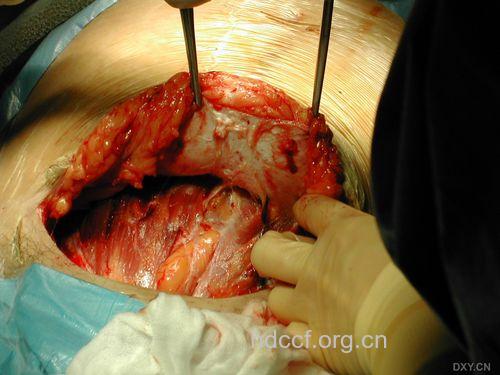 剖腹产手术震撼图片