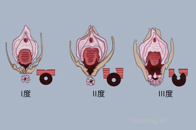 分娩时 会阴撕裂伤分级示意图