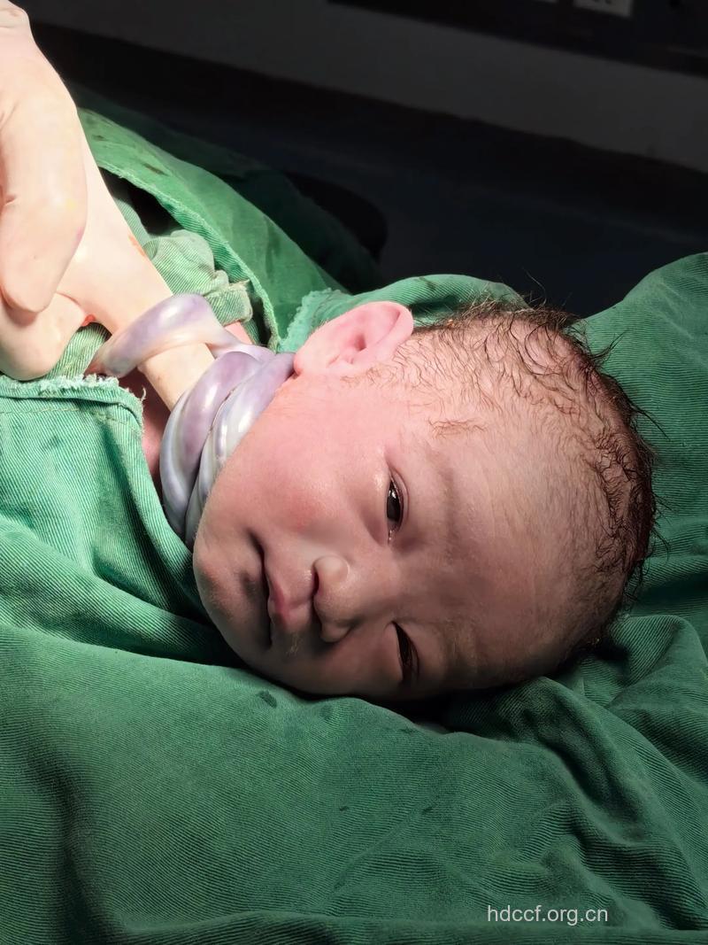 脐带绕颈就必须剖宫产吗