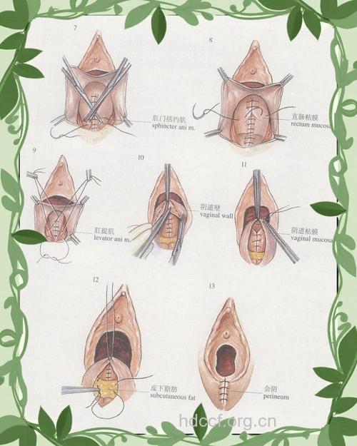 哪些顺产情况要侧切