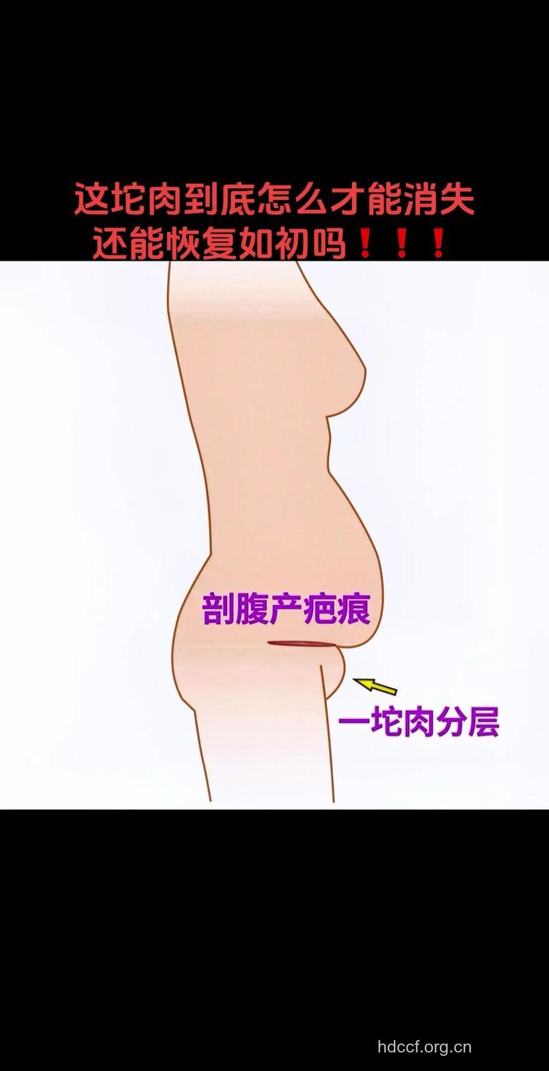 剖腹产更容易保持身材吗