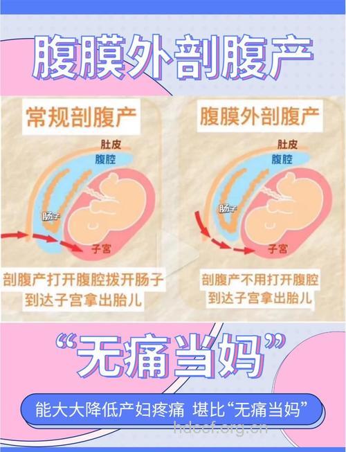 解析剖腹产的优缺点