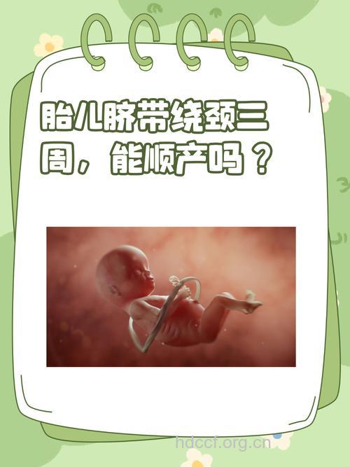 脐带绕颈三周能顺产吗 脐带绕颈怎么回事