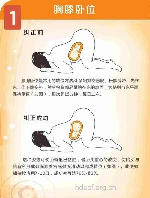 胎位不正要选择剖腹产吗