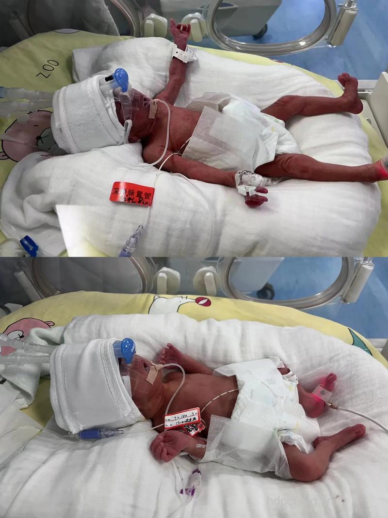 婴儿为什么会早产?