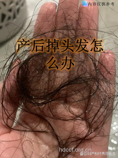 哺乳期大把掉头发 新妈妈可以这样做
