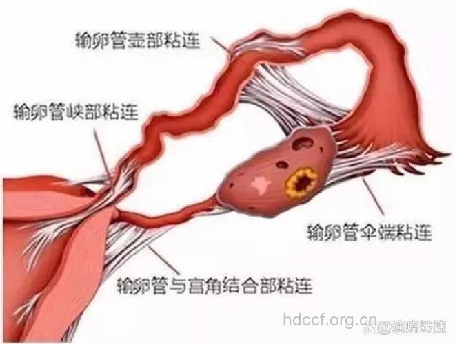输卵管粘连